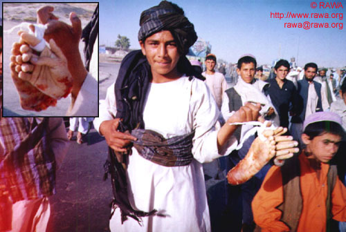 Handcut by Taliban in Kabul