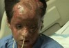March 14, 2009, 8-year-old girl burned by white phosphorus munitions