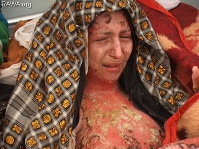 Gulbar was burnt by her cruel husband