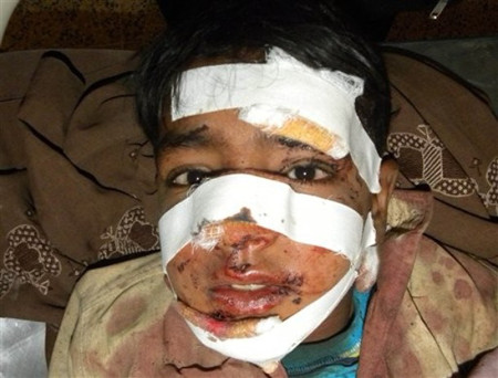A Pakistani survivor of the blast in Kandahar on January 7, 2011
