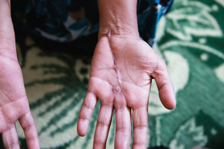 A knife attack by this woman's husband left the scar on her palm in Herat Afghanistan