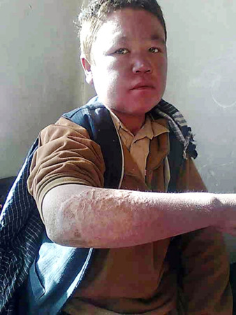 Boy with leprosy