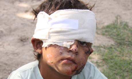 Little boy who lost his eye in IED explosion