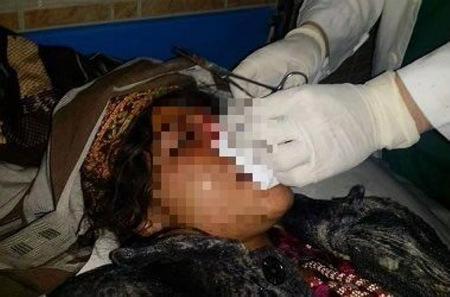Womans nose was cut by her husband in northern Afghanistan