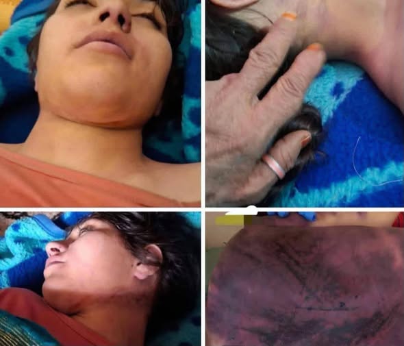Farzana with injuries covering her face and body